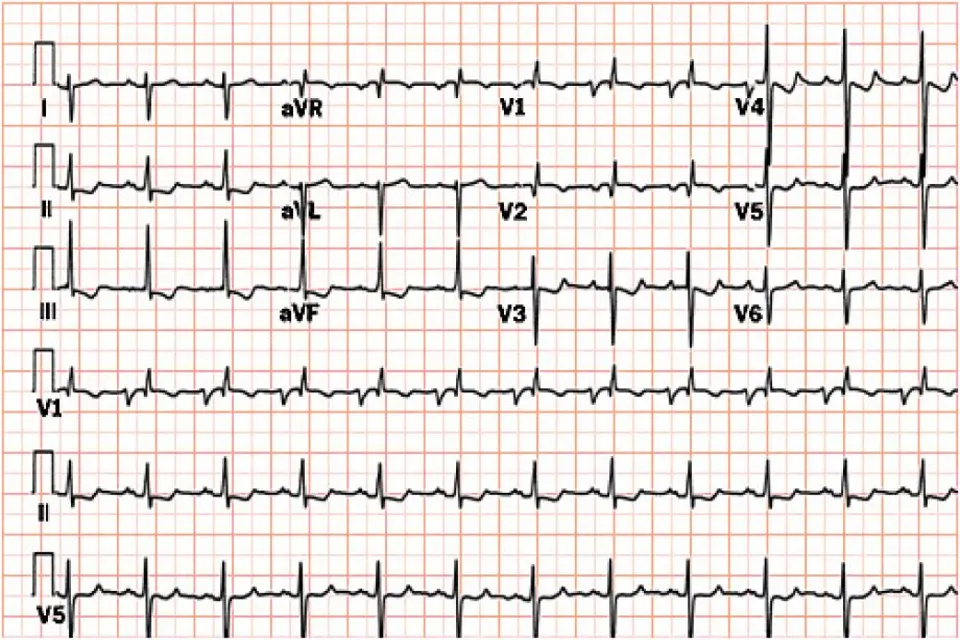 EKG Cihazı Kalbin Ritmini Kaydeden Teknoloji Harikası - 3